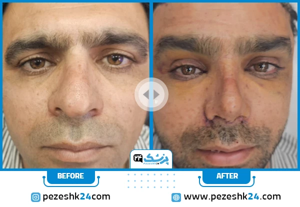 قبل و بعد لیفت صورت دکتر مهرابی شیراز