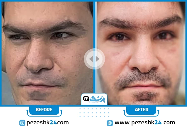 قبل و بعد جراحی لیفت صورت دکتر مهرابی شیراز