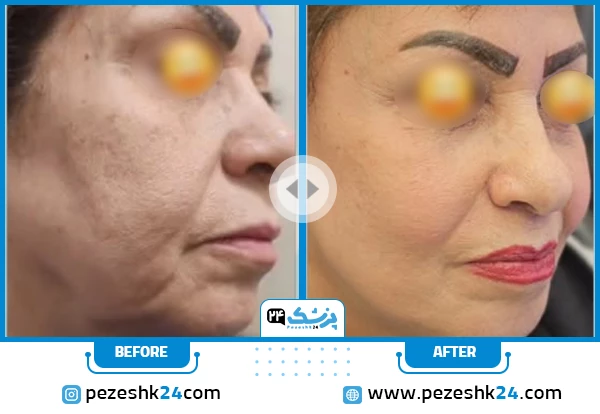 قبل و بعد لیفت صورت دکتر مهرابی شیراز