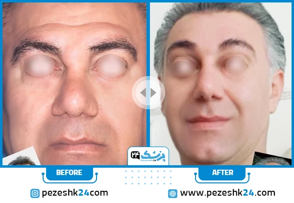 قبل و بعد لیفت صورت دکتر معتضدیان