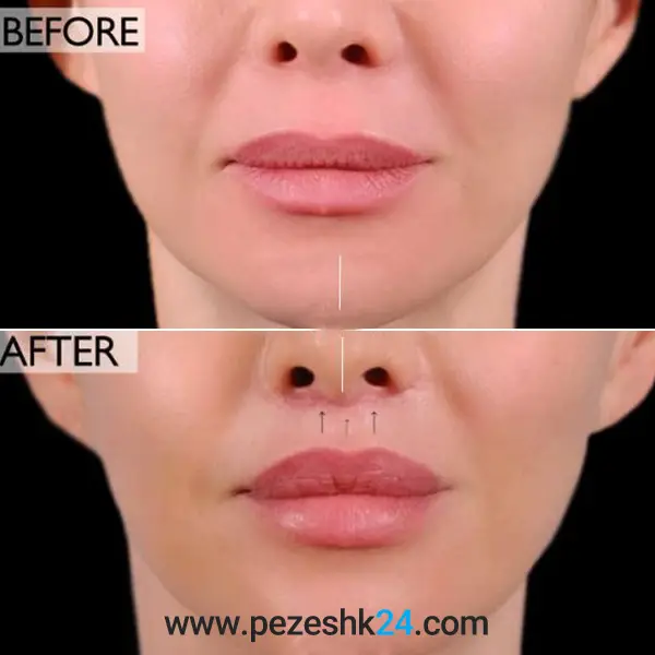 قبل و بعد سانترال لب در اصفهان