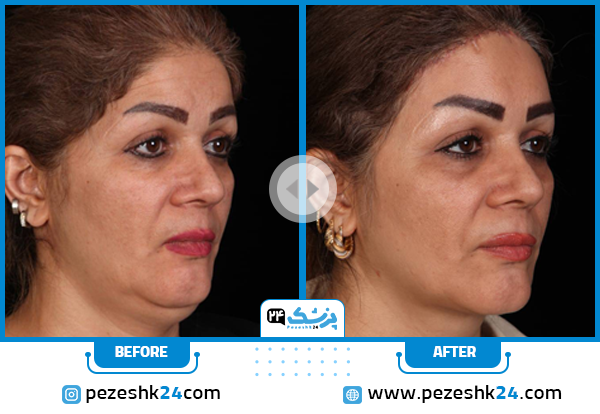 نمونه کار قبل و بعد بهترین کلینیک لیفت شقیقه در اصفهان کلینیک سینایار