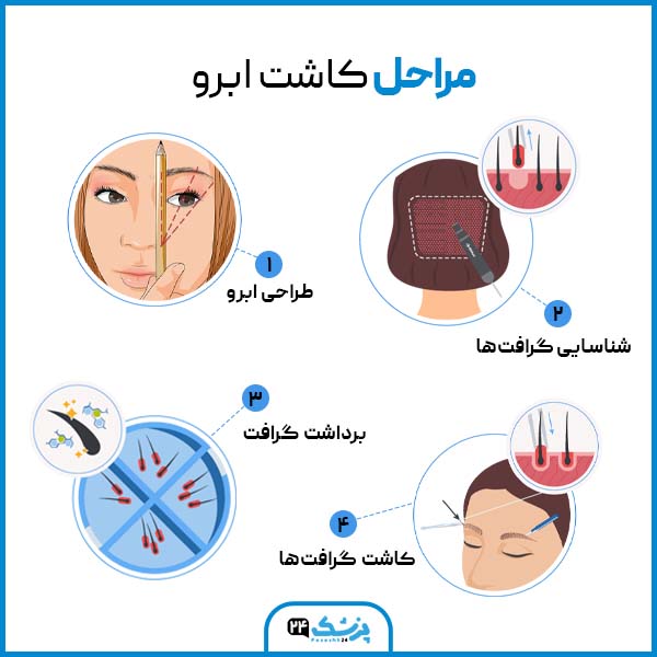 مراحل جراحی کاشت ابرو