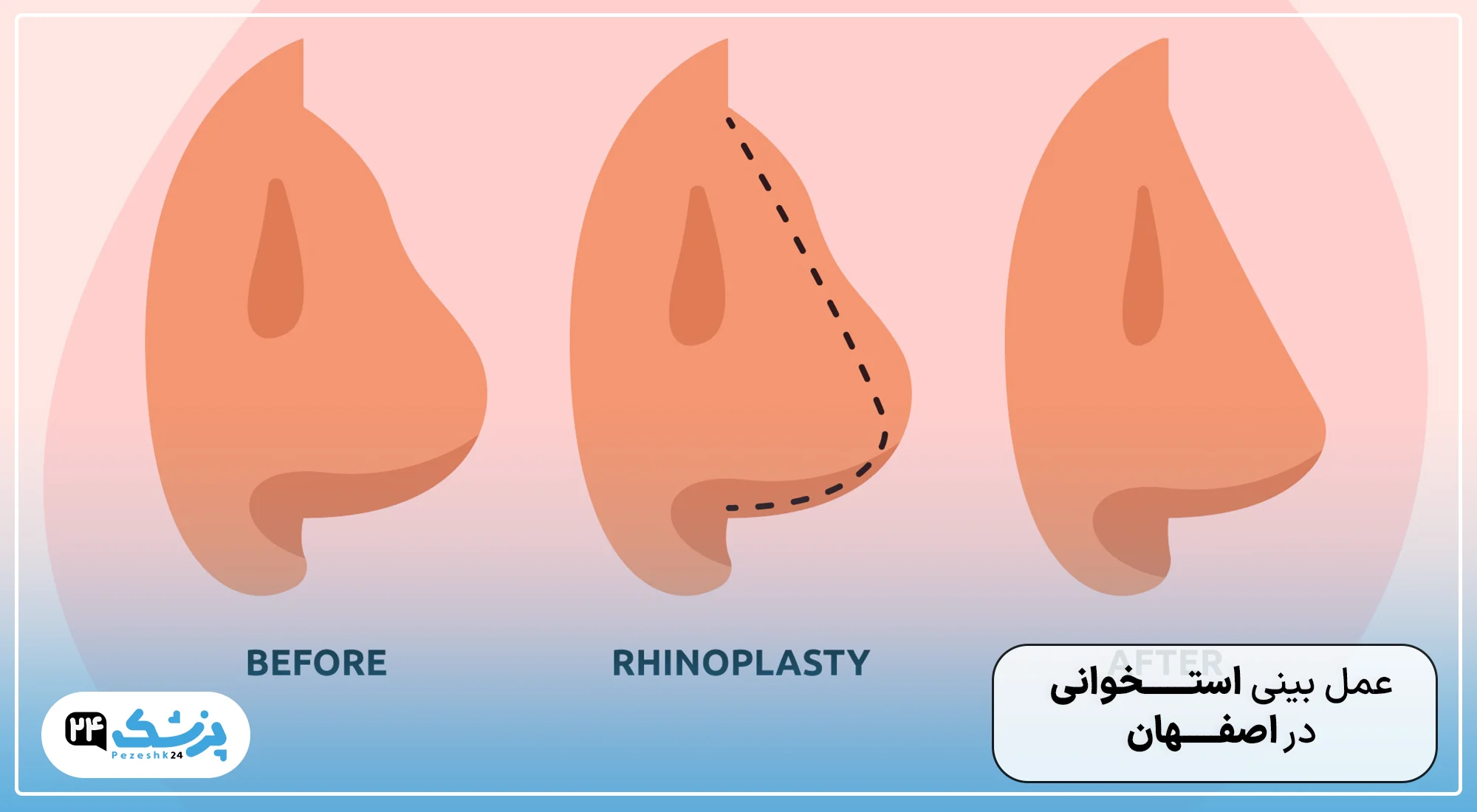 بهترین جراح بینی استخوانی در اصفهان
