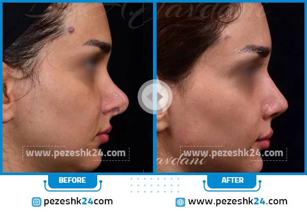 عکس قبل و بعد عمل ترمیم بینی