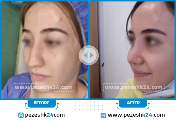 قبل و بعد جراحی بینی دکتر رجب پور