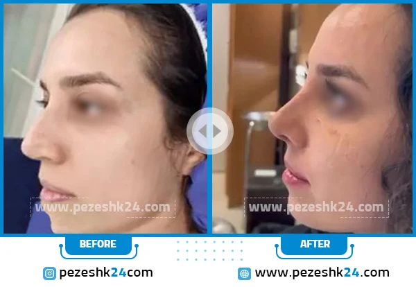قبل و بعد رینوپلاستی دکتر رجب پور
