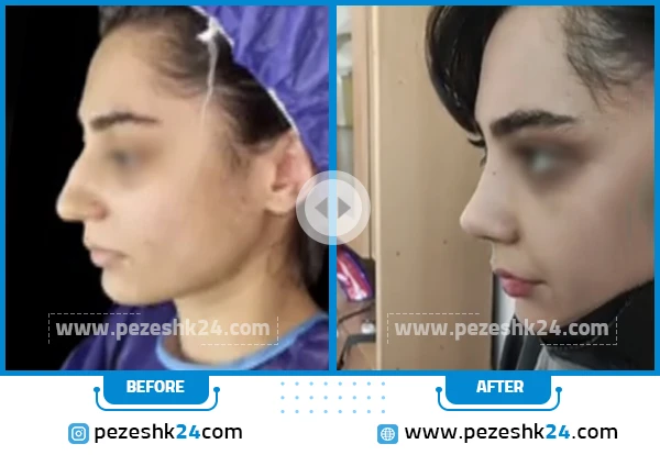 قبل و بعد عمل بینی دکتر رجب پور تهران