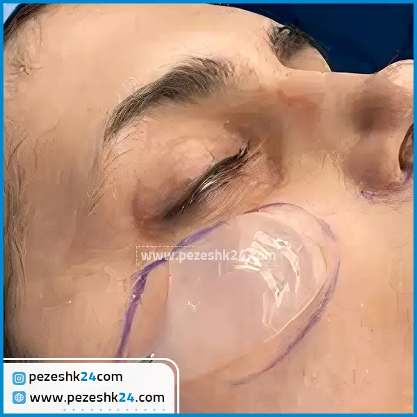 قیمت پروتز گونه گذاری اصفهان