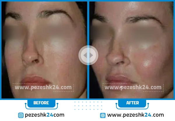 قبل و بعد پروتز گونه در اصفهان