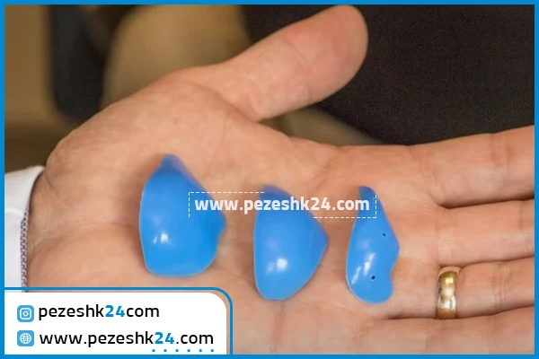 انواع پروتز گونه اصفهان