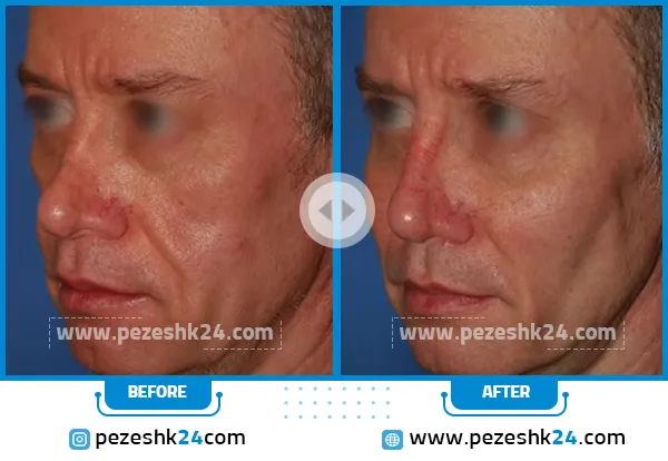 پروتز طبیعی گونه در اصفهان