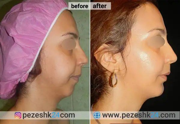 قبل و بعد جراحی چانه دکتر غیاثی شیراز