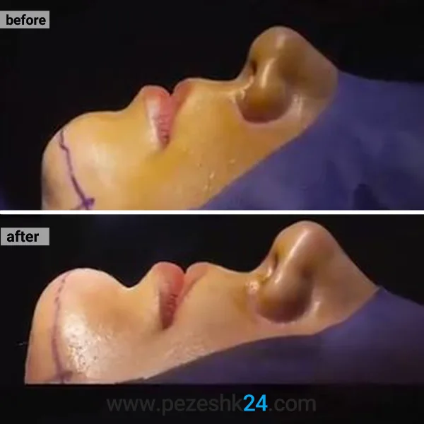 قبل و بعد جراحی پروتز چانه دکتر غیاثی