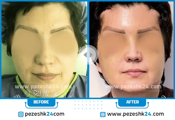 قبل و بعد لیفت صورت دکتر معتمدی فر