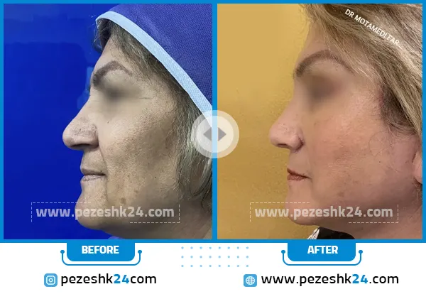 قبل و بعد لیفت صورت دکتر معتمدی فر مشهد