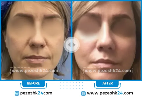 قبل و بعد لیفت صورت دکتر جلال معتمدی فر