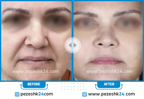 قبل و بعد لیفت صورت دکتر زارع مشهد