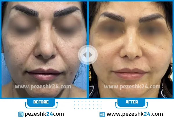 قبل و بعد لیفت صورت دکتر زارع