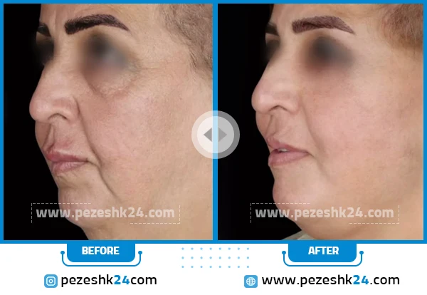 قبل و بعد جراحی لیفت صورت دکتر زارع