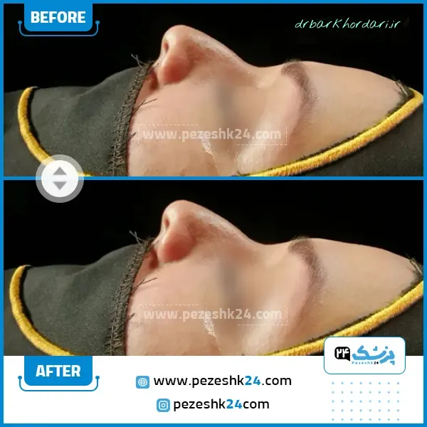 قبل و بعد جراحی بینی دکتر برخورداری