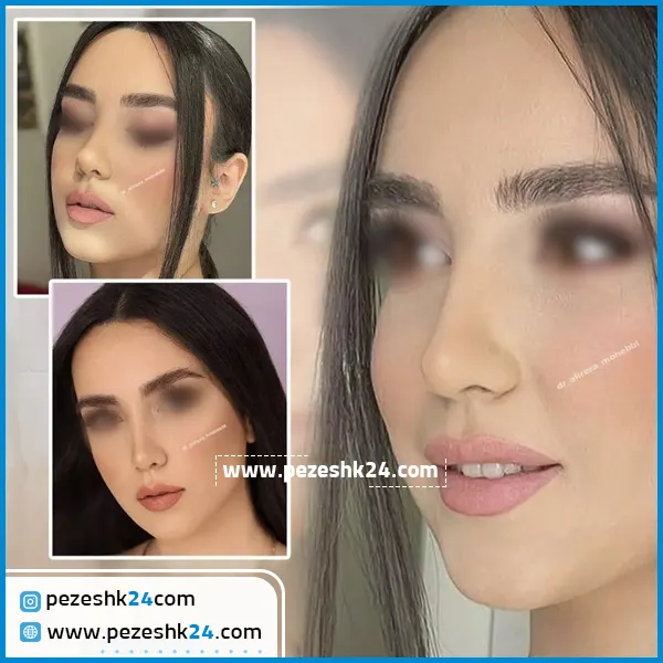 نمونه جراحی بینی دکتر محبی تهران