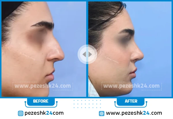 قبل و بعد رینوپلاستی دکتر محبی تهران