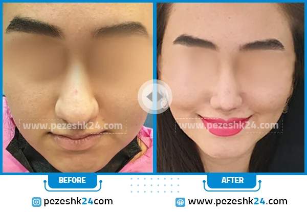 نمونه عمل بینی دکتر گندمی شیراز