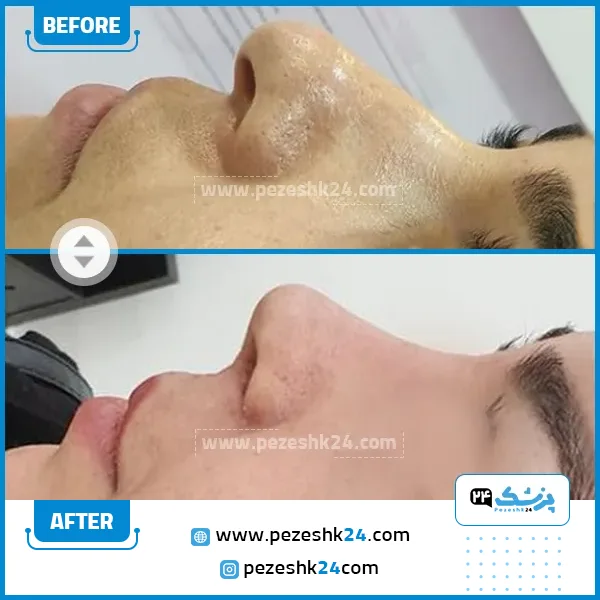 قبل و بعد عمل بینی دکتر گندمی