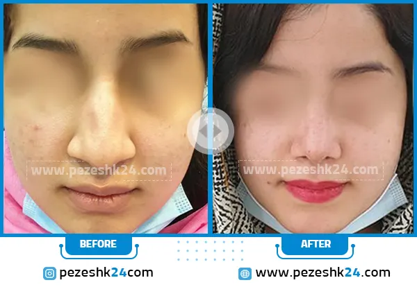 قبل و بعد جراحی بینی دکتر بهروز گندمی