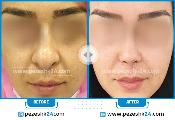 نمونه عمل بینی از دکتر گندمی شیراز