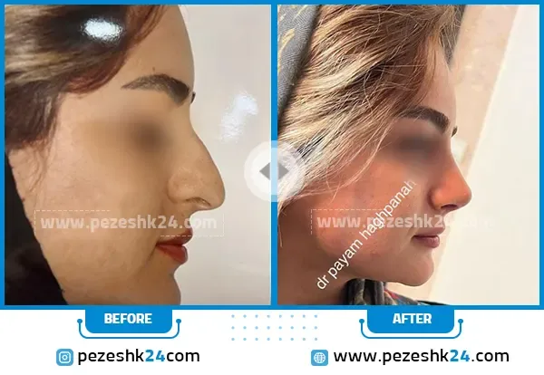 نمونه عمل بینی دکتر حق پناه شیراز