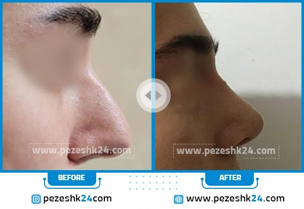 نمونه عمل بینی دکتر رضوانی نیا شیراز