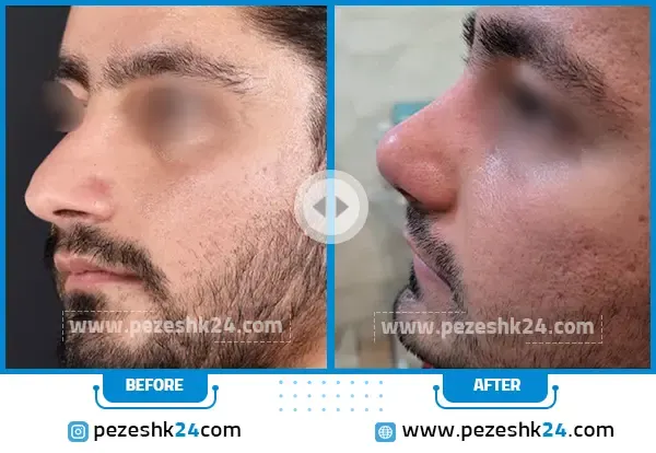 جراحی بینی دکتر رضوانی نیا در شیراز