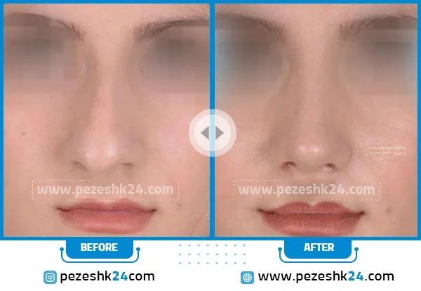 عکس نمونه قبل و بعد جراحی بینی دکتر عین ابادی