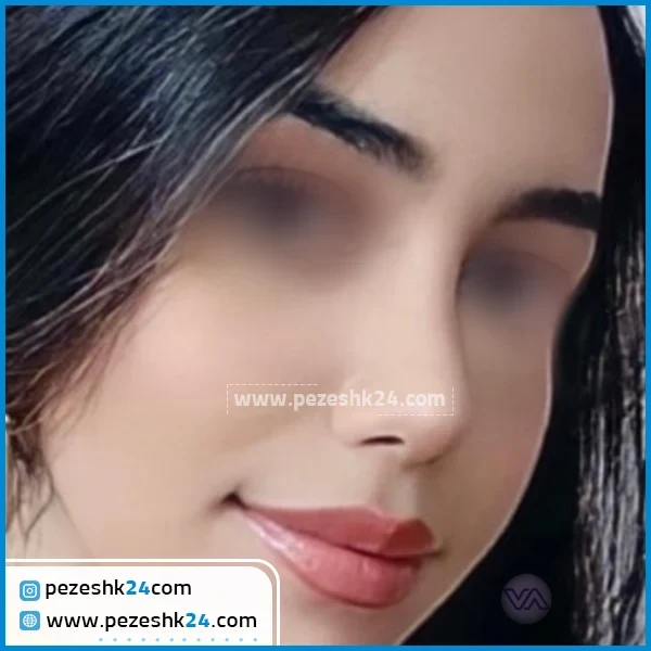 نمونه عمل بینی دکتر ونون آصفی