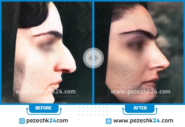 قبل و بعد عمل بینی دکتر یوشی