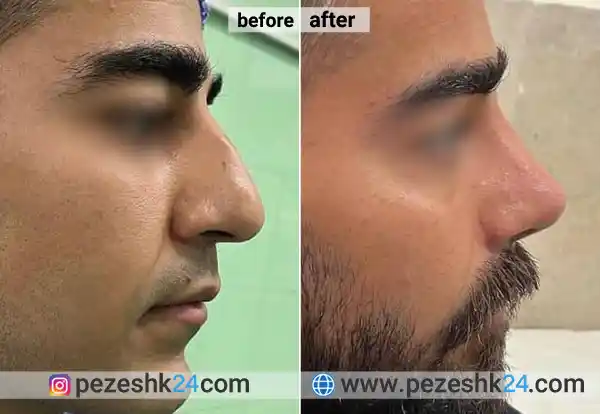 قبل و بعد جراحی بینی دکتر موسوی
