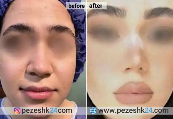 نمونه جراحی بینی از دکتر موسوی