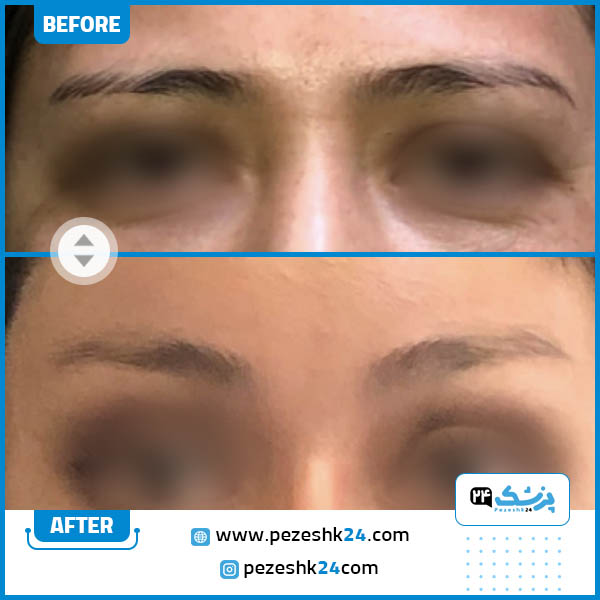 قبل و بعد عمل جراحی لیفت شقیقه دکتر حمید ولی زاده مقدم