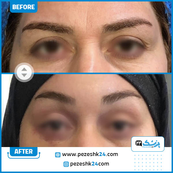 قبل و بعد از عمل جراحی لیفت شقیقه دکتر حمید ولی زاده مقدم