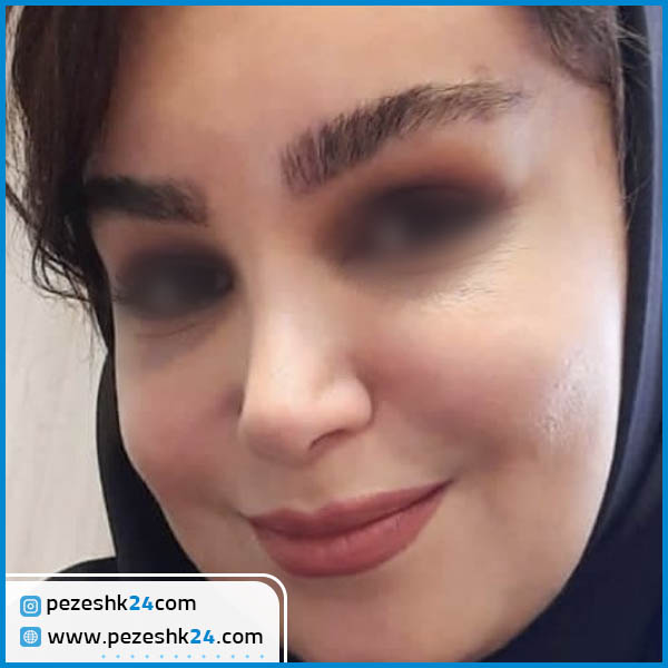 عمل جراحی لیفت شقیقه دکتر حمید ولی زاده مقدم