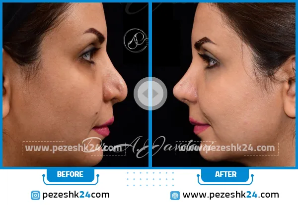 عکس قبل و بعد عمل بینی ترمیمی جاودانی تهران
