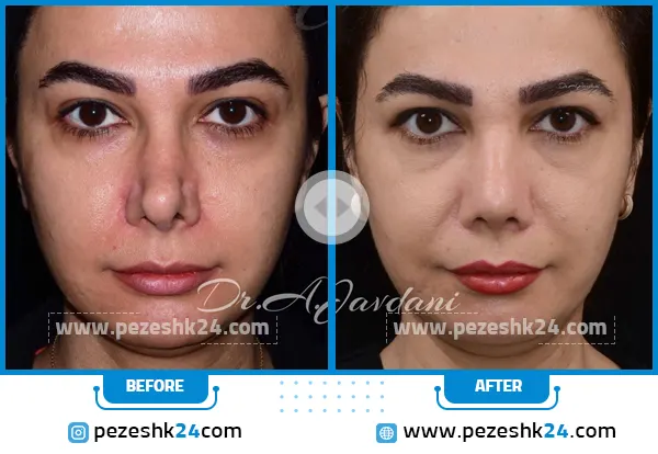 عمل بینی ترمیمی دکتر جاودانی تهران