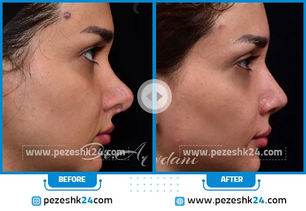 عکس قبل و بعد عمل بینی ترمیمی- دکتر جاودانی