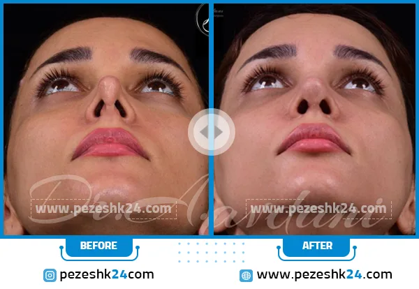 عکس قبل و بعد عمل بینی ترمیمی دکتر جاودانی