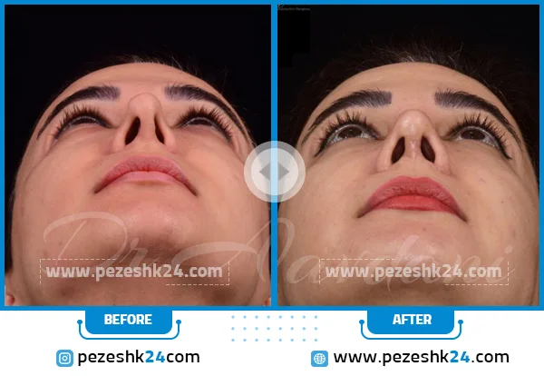 نمونه کار بینی ترمیمی تهران