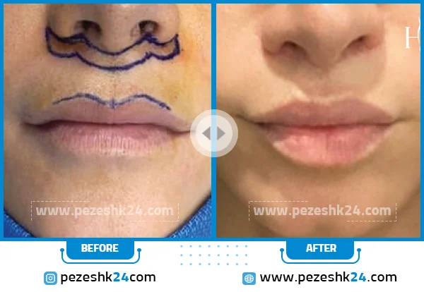 بهترین دکتر سانترال لب در شیراز