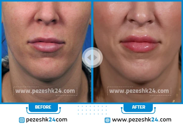 دکتر خوب برای لیفت لب در شیراز