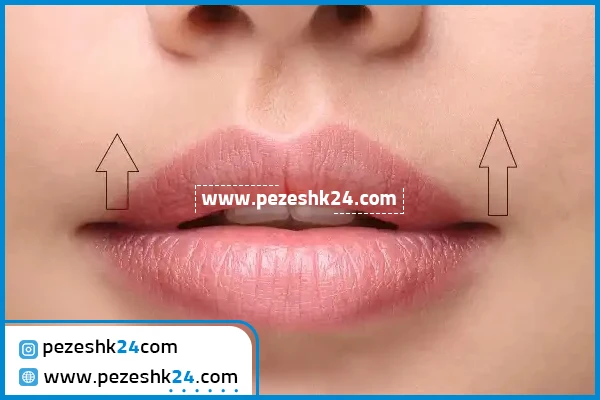 عمل بالا کشیدن لب در شیراز
